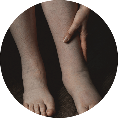 Lymfoedeem behandelen bij Bewuster en Gezonder in Kesteren