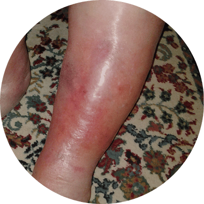 Bij wondroos geen lymfedrainage massage zegt Bewuster en Gezonder in Kesteren