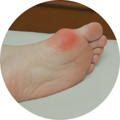 Betekenis Hallux Valgus door Bewuster en Gezonder in Kesteren